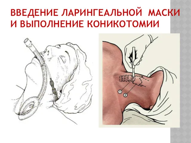 ВВЕДЕНИЕ ЛАРИНГЕАЛЬНОЙ МАСКИ И ВЫПОЛНЕНИЕ КОНИКОТОМИИ