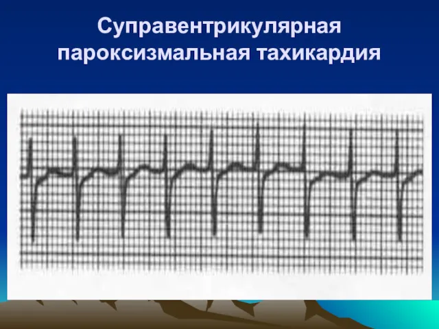 Суправентрикулярная пароксизмальная тахикардия