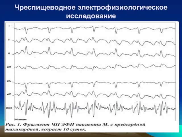 Чреспищеводное электрофизиологическое исследование