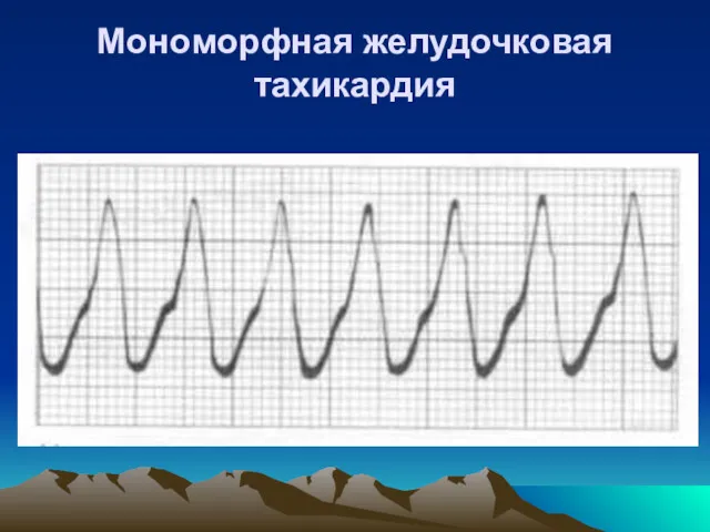 Мономорфная желудочковая тахикардия