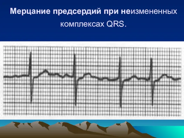 Мерцание предсердий при неизмененных комплексах QRS.