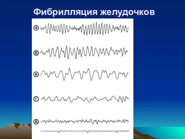 Фибрилляция желудочков