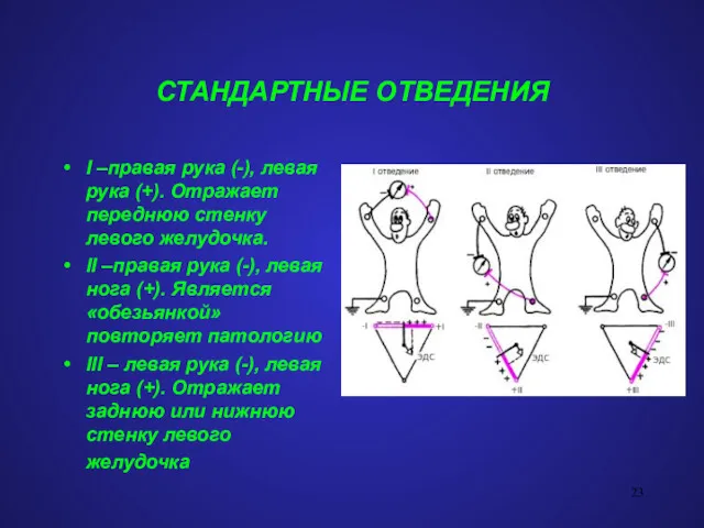 СТАНДАРТНЫЕ ОТВЕДЕНИЯ I –правая рука (-), левая рука (+). Отражает