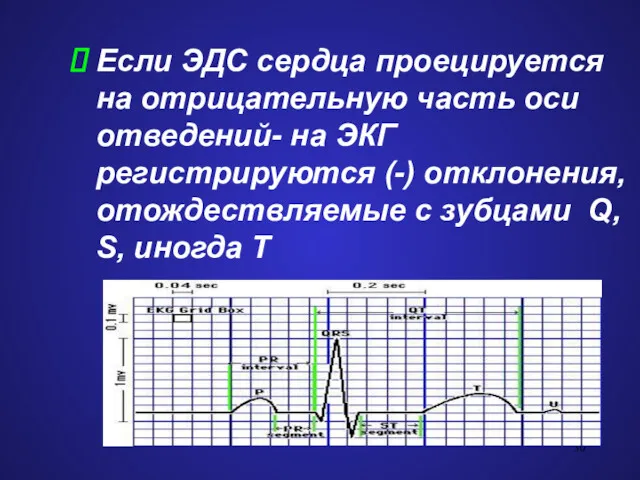 Если ЭДС сердца проецируется на отрицательную часть оси отведений- на