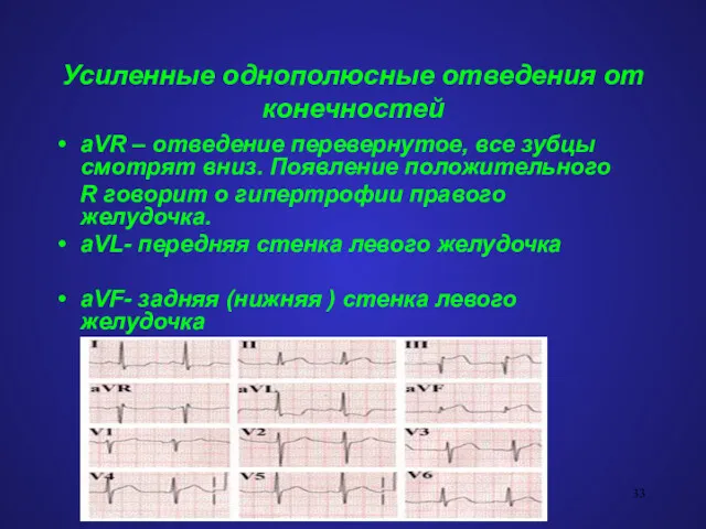 Усиленные однополюсные отведения от конечностей aVR – отведение перевернутое, все