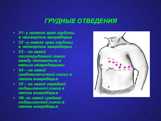 ГРУДНЫЕ ОТВЕДЕНИЯ V1- у правого края грудины в четвертом межреберье