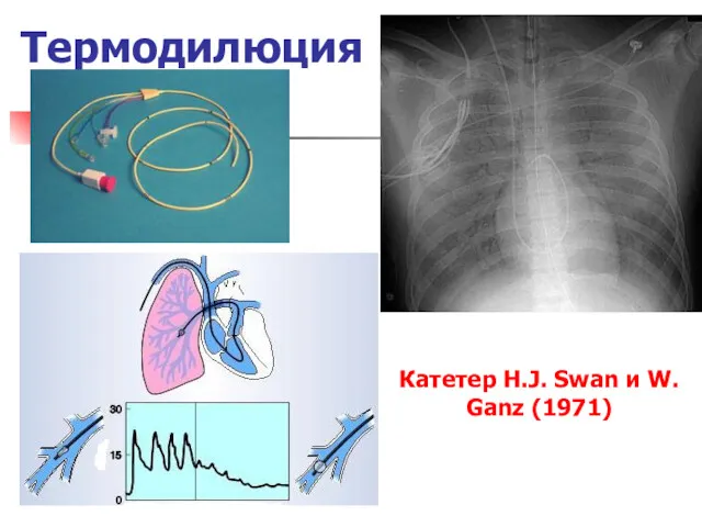 Термодилюция Катетер H.J. Swan и W. Ganz (1971)