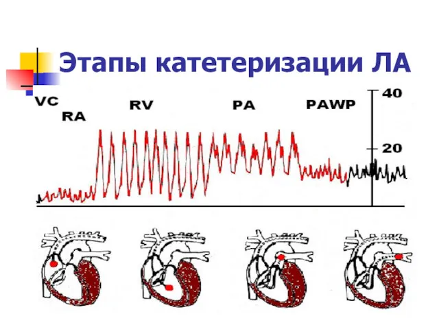 Этапы катетеризации ЛА