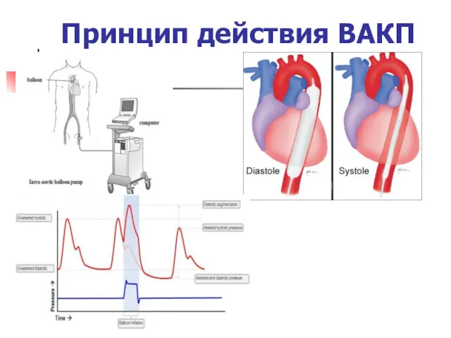 Принцип действия ВАКП