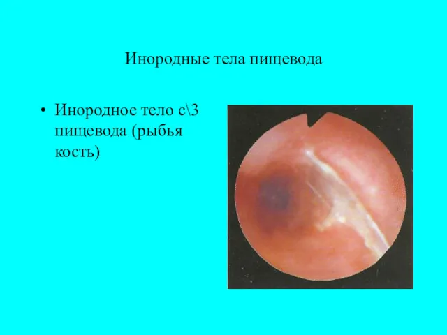 Инородные тела пищевода Инородное тело с\3 пищевода (рыбья кость)