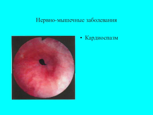 Нервно-мышечные заболевания Кардиоспазм