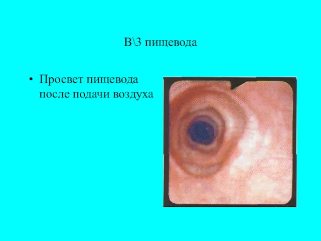 В\3 пищевода Просвет пищевода после подачи воздуха