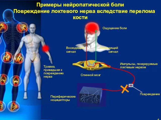 Примеры нейропатической боли Повреждение локтевого нерва вследствие перелома кости Восходящий