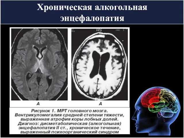 Хроническая алкогольная энцефалопатия