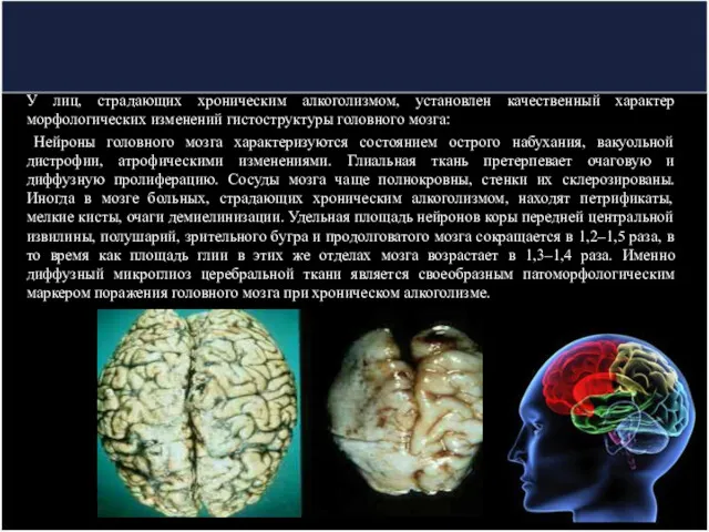У лиц, страдающих хроническим алкоголизмом, установлен качественный характер морфологических изменений