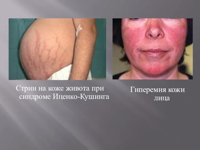 Стрии на коже живота при синдроме Иценко-Кушинга Гиперемия кожи лица