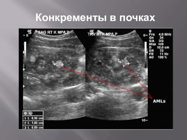 Конкременты в почках