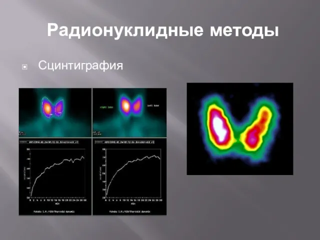 Радионуклидные методы Сцинтиграфия