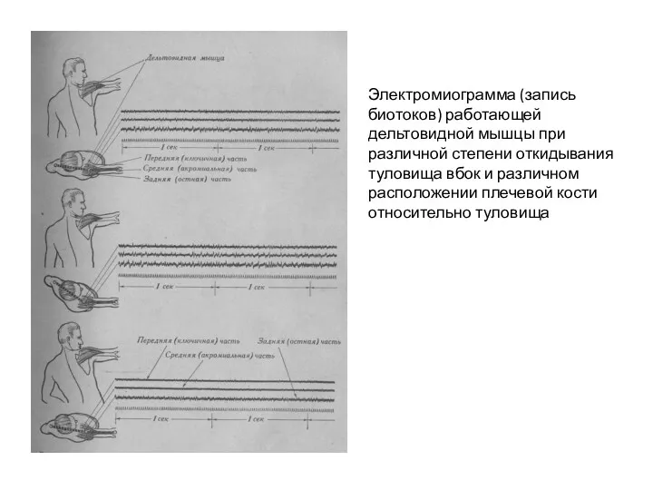 Электромиограмма (запись биотоков) работающей дельтовидной мышцы при различной степени откидывания