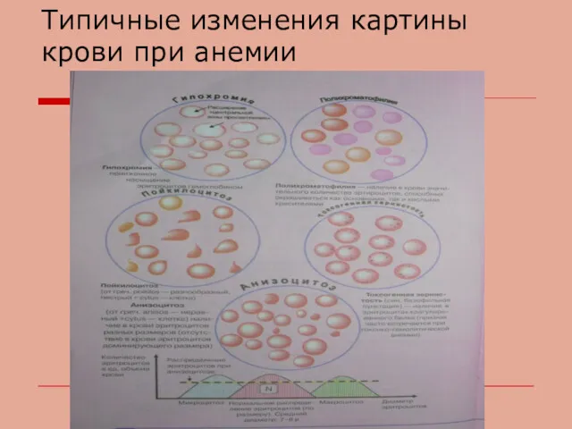 Типичные изменения картины крови при анемии