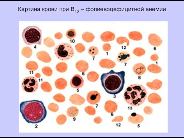 Картина крови при В12 – фолиеводефицитной анемии