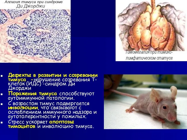 Дефекты в развитии и созревании тимуса -нарушение созревания Т-клеток (ИДС)