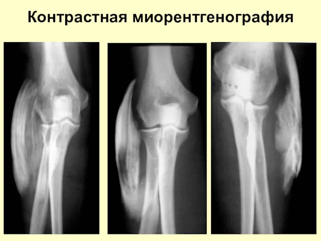 Контрастная миорентгенография