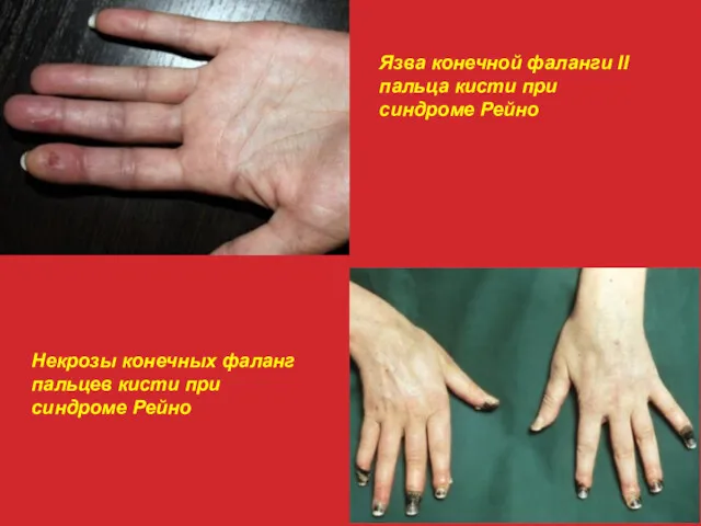 Язва конечной фаланги II пальца кисти при синдроме Рейно Некрозы