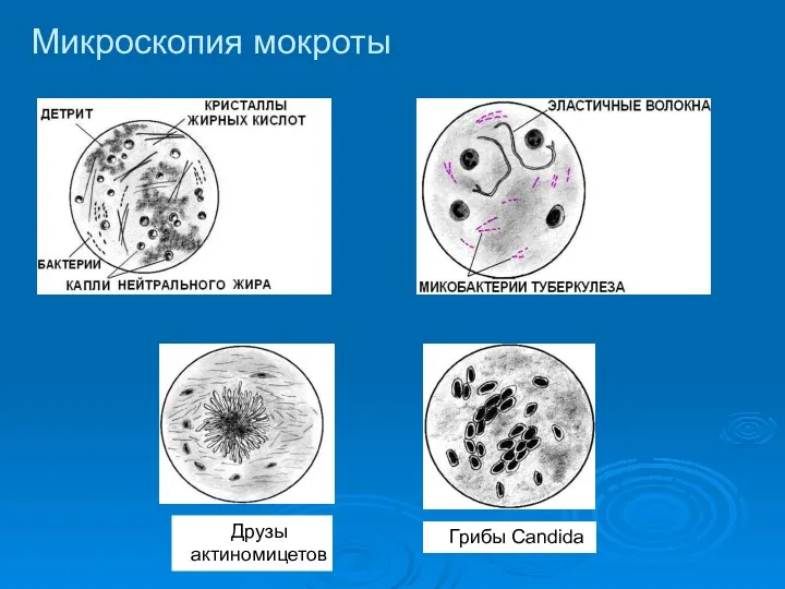 Друзы актиномицетов Грибы Candida Микроскопия мокроты