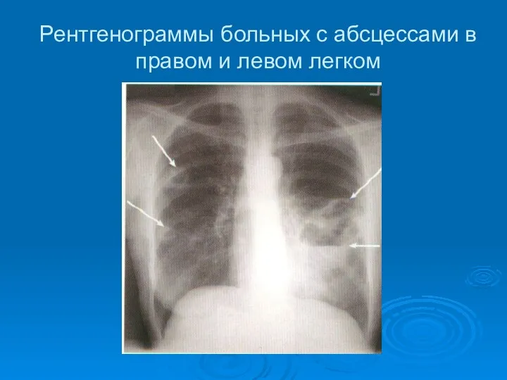 Рентгенограммы больных с абсцессами в правом и левом легком