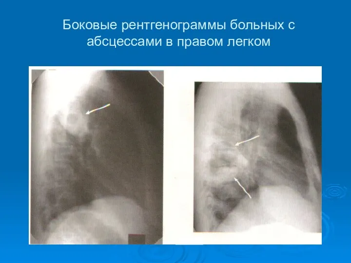 Боковые рентгенограммы больных с абсцессами в правом легком