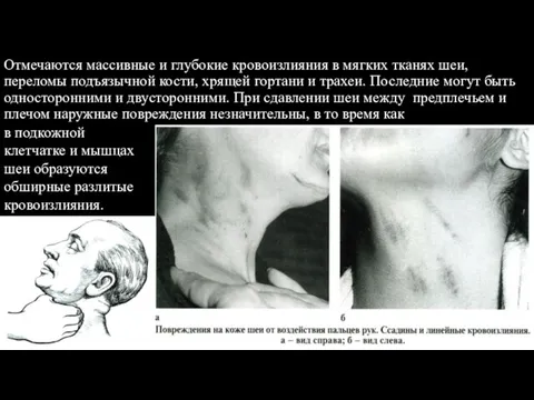 Отмечаются массивные и глубокие кровоизлияния в мягких тканях шеи, переломы