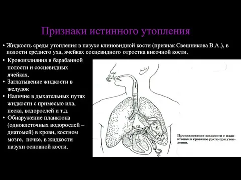 Жидкость среды утопления в пазухе клиновидной кости (признак Свешникова В.А.),