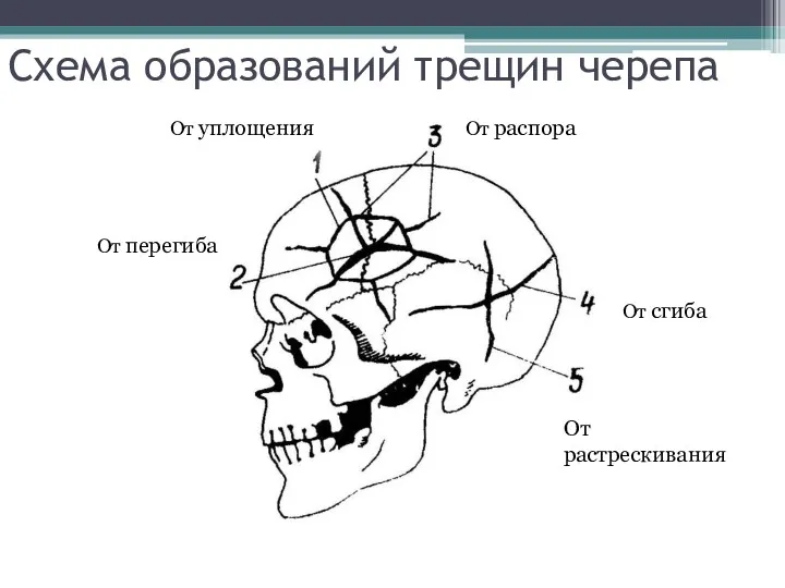 Схема образований трещин черепа От уплощения От перегиба От распора От сгиба От растрескивания