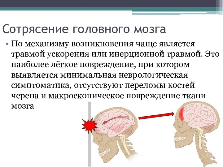 Сотрясение головного мозга По механизму возникновения чаще является травмой ускорения