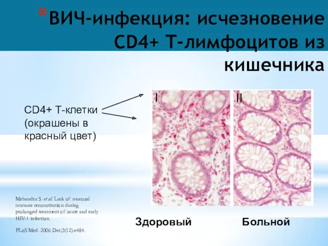 ВИЧ-инфекция: исчезновение CD4+ T-лимфоцитов из кишечника Здоровый Больной CD4+ T-клетки