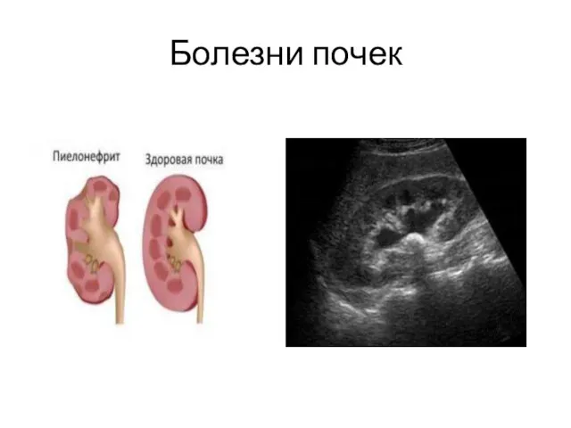 Болезни почек