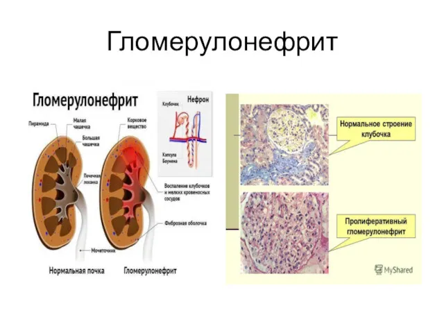 Гломерулонефрит