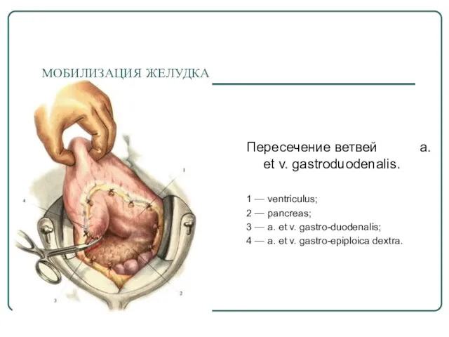 МОБИЛИЗАЦИЯ ЖЕЛУДКА Пересечение ветвей a. et v. gastroduodenalis. 1 — ventriculus; 2 —
