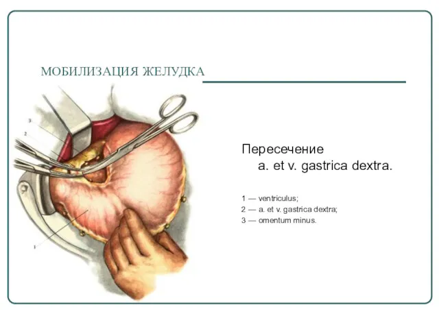 МОБИЛИЗАЦИЯ ЖЕЛУДКА Пересечение a. et v. gastrica dextra. 1 — ventriculus; 2 —