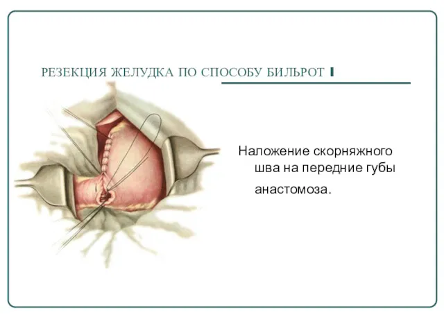 РЕЗЕКЦИЯ ЖЕЛУДКА ПО СПОСОБУ БИЛЬРОТ I Наложение скорняжного шва на передние губы анастомоза.