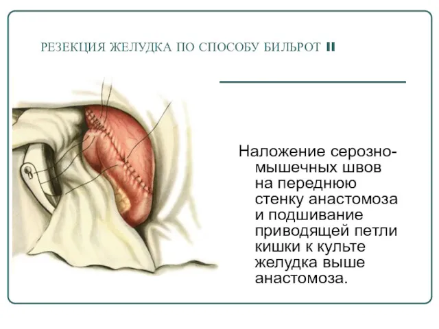 РЕЗЕКЦИЯ ЖЕЛУДКА ПО СПОСОБУ БИЛЬРОТ II Наложение серозно-мышечных швов на переднюю стенку анастомоза