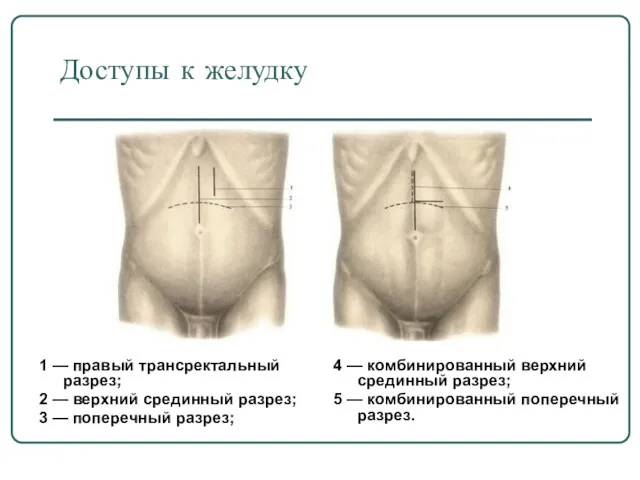 Доступы к желудку 1 — правый трансректальный разрез; 2 — верхний срединный разрез;