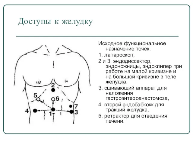 Доступы к желудку Исходное функциональное назначение точек: 1. лапароскоп, 2 и 3. эндодиссектор,