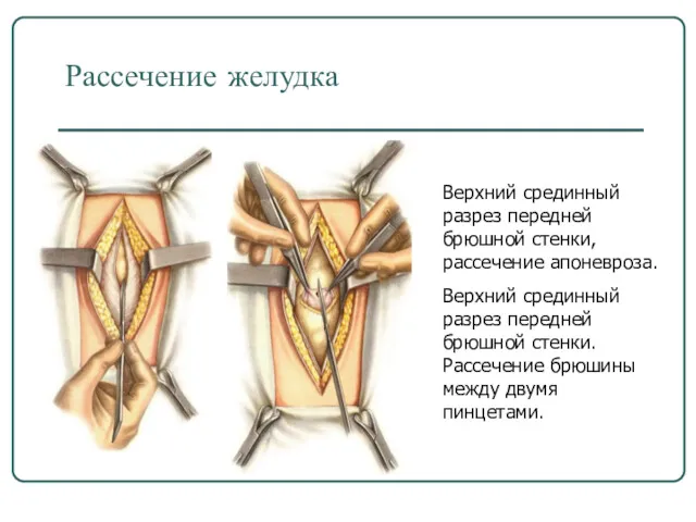 Верхний срединный разрез передней брюшной стенки, рассечение апоневроза. Верхний срединный разрез передней брюшной