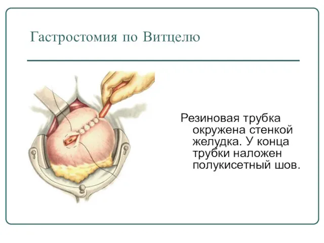 Гастростомия по Витцелю Резиновая трубка окружена стенкой желудка. У конца трубки наложен полукисетный шов.