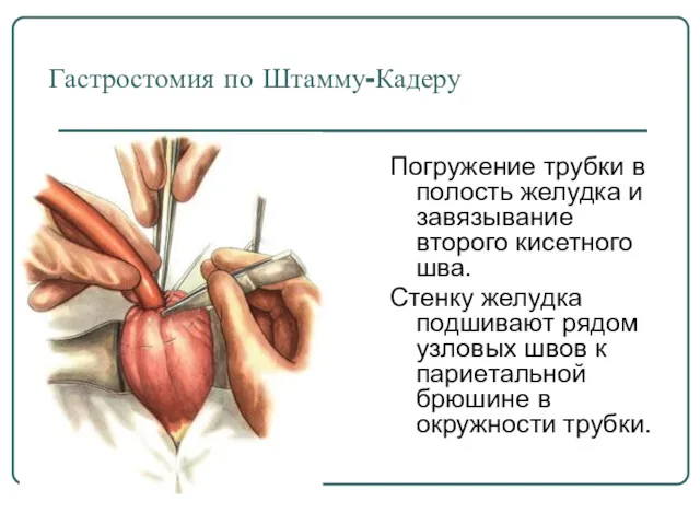 Погружение трубки в полость желудка и завязывание второго кисетного шва. Стенку желудка подшивают