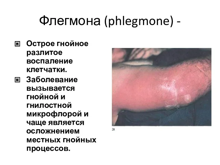 Флегмона (phlegmone) - Острое гнойное разлитое воспаление клетчатки. Заболевание вызывается гнойной и гнилостной
