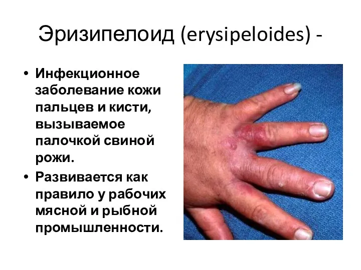 Эризипелоид (erysipeloides) - Инфекционное заболевание кожи пальцев и кисти, вызываемое палочкой свиной рожи.