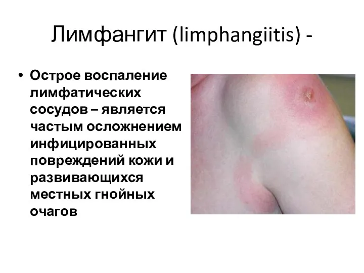 Лимфангит (limphangiitis) - Острое воспаление лимфатических сосудов – является частым